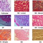 Ai que describe el cáncer de paciente con una precisión perfecta